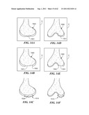Patient Selectable Joint Arthroplasty Devices and Surgical Tools diagram and image