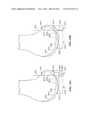 Patient Selectable Joint Arthroplasty Devices and Surgical Tools diagram and image