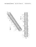 ANGIOPLASTY STENTS diagram and image