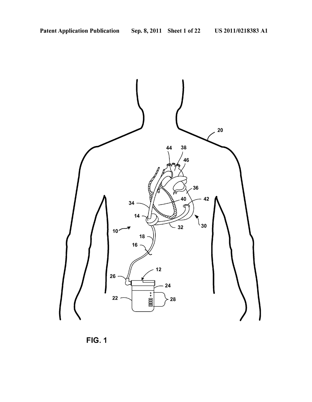 PORTABLE CONTROLLER AND POWER SOURCE FOR MECHANICAL CIRCULATION SUPPORT     SYSTEMS - diagram, schematic, and image 02