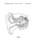 Incus Replacement Partial Ossicular Replacement Prosthesis diagram and image