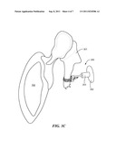 Incus Replacement Partial Ossicular Replacement Prosthesis diagram and image