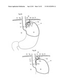 APPARATUS AND METHOD FOR TREATING GERD diagram and image