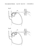 APPARATUS AND METHOD FOR TREATING GERD diagram and image