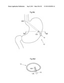 APPARATUS AND METHOD FOR TREATING GERD diagram and image