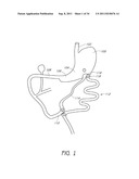 APPARATUS AND METHOD FOR GASTRIC BYPASS SURGERY diagram and image