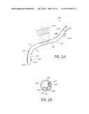 APPARATUS AND METHOD FOR GASTRIC BYPASS SURGERY diagram and image