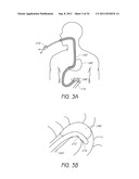 APPARATUS AND METHOD FOR GASTRIC BYPASS SURGERY diagram and image