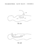 APPARATUS AND METHOD FOR GASTRIC BYPASS SURGERY diagram and image