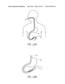 APPARATUS AND METHOD FOR GASTRIC BYPASS SURGERY diagram and image