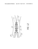 APPARATUS AND METHOD FOR GASTRIC BYPASS SURGERY diagram and image