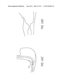 APPARATUS AND METHOD FOR GASTRIC BYPASS SURGERY diagram and image