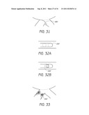 APPARATUS AND METHOD FOR GASTRIC BYPASS SURGERY diagram and image