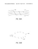 APPARATUS AND METHOD FOR GASTRIC BYPASS SURGERY diagram and image