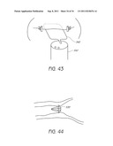 APPARATUS AND METHOD FOR GASTRIC BYPASS SURGERY diagram and image