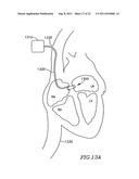 DEVICE AND METHOD FOR CONTROLLING IN-VIVO PRESSURE diagram and image