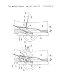 SYSTEMS AND METHODS FOR TRANSEPTAL CARDIAC PROCEDURES, INCLUDING     ADJUSTABLE, SEPARABLE GUIDEWIRES diagram and image