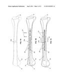 ENDOSTEAL NAIL PLATE FOR FIXING BONE SEGMENTS diagram and image