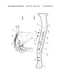 ENDOSTEAL NAIL PLATE FOR FIXING BONE SEGMENTS diagram and image