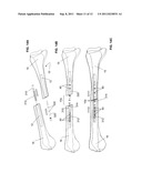 ENDOSTEAL NAIL PLATE FOR FIXING BONE SEGMENTS diagram and image