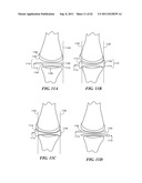 Patient Selectable Joint Arthroplasty Devices and Surgical Tools diagram and image