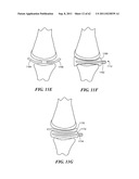 Patient Selectable Joint Arthroplasty Devices and Surgical Tools diagram and image