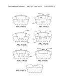 Patient Selectable Joint Arthroplasty Devices and Surgical Tools diagram and image