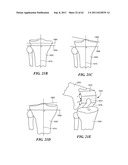 Patient Selectable Joint Arthroplasty Devices and Surgical Tools diagram and image