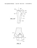 Patient Selectable Joint Arthroplasty Devices and Surgical Tools diagram and image