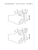 Patient Selectable Joint Arthroplasty Devices and Surgical Tools diagram and image