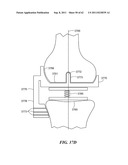 Patient Selectable Joint Arthroplasty Devices and Surgical Tools diagram and image