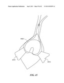 Patient Selectable Joint Arthroplasty Devices and Surgical Tools diagram and image