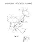 Patient Selectable Joint Arthroplasty Devices and Surgical Tools diagram and image