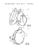 PATIENT-SPECIFIC COMPUTED TOMOGRAPHY GUIDES diagram and image