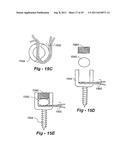 METHODS AND APPARATUS FOR ANULUS REPAIR diagram and image