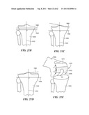 Patient Selectable Joint Arthroplasty Devices and Surgical Tools diagram and image