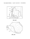 Patient Selectable Joint Arthroplasty Devices and Surgical Tools diagram and image