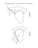 Patient Selectable Joint Arthroplasty Devices and Surgical Tools diagram and image