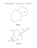 Patient Selectable Joint Arthroplasty Devices and Surgical Tools diagram and image