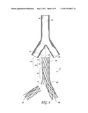 ENDOLUMINAL VASCULAR PROSTHESIS diagram and image