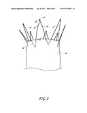 ENDOLUMINAL VASCULAR PROSTHESIS diagram and image