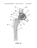 Interlocking reverse hip prosthesis diagram and image