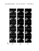 METHOD FOR DIAGNOSING NON-SMALL CELL LUNG CANCER diagram and image