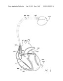 Systems and Methods for Use By an Implantable Medical Device for Detecting     and Discriminating Stroke and Cardiac Ischemia Using Electrocardiac     Signals and Hemodynamic Parameters diagram and image