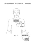 Systems and Methods for Use By an Implantable Medical Device for Detecting     and Discriminating Stroke and Cardiac Ischemia Using Electrocardiac     Signals and Hemodynamic Parameters diagram and image