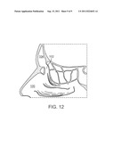 FRONTAL SINUS DILATION CATHETER diagram and image