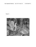 MINIMALLY INVASIVE TREATMENT OF VERTEBRA (MITV) USING A CALCIUM PHOSPHATE     COMBINATION BONE CEMENT diagram and image