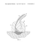 Tissue Debridement Systems and Methods diagram and image