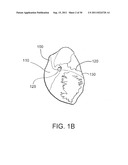 DEVICES, SYSTEMS, AND METHODS FOR CLOSING A HOLE IN CARDIAC TISSUE diagram and image