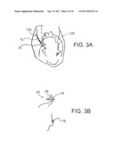 DEVICES, SYSTEMS, AND METHODS FOR CLOSING A HOLE IN CARDIAC TISSUE diagram and image